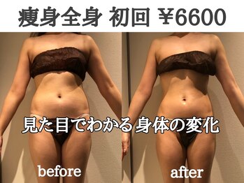 ティースリー(T-THREE)/大人気のキャビテーション★