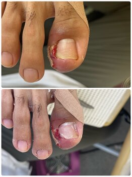 巻き爪じゅん 船橋店/陥入爪による痛み改善！