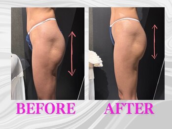 ザモア 福岡天神(THE MORE)/ヒップ【症例 Before After】