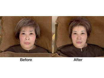 こじま 富雄団地接骨院/フェイスライン・たるみ