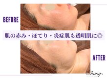 サンク(Thanq)/肌の赤み・日焼け後火照り