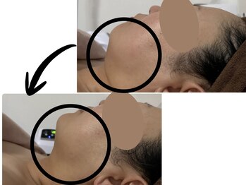 カリアンヌの写真/【小顔食いしばり】頭痛・酷い肩こりも改善★温熱シェルでエラ張りたるみ/むくみを引き締めシャープな顔へ
