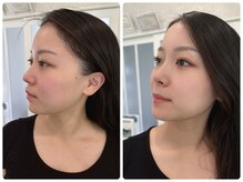 アンベリール(EMBELLIR)/ご新規限定フェイシャルプラン