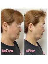 小顔整体 優/二重アゴ撃退☆