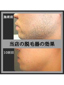 ケイエス(K's)/髭 脱毛