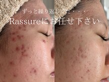 ラシュール(Rassure)/コモデックス　Before/After