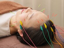 はりきゅう整骨院 健志/電気を流すハリでリフトアップ