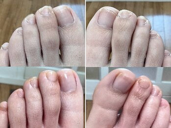 リゼランアンドコー 福島鎌田店(LIZERA&Co)の写真/長年の足のトラブルに改善ケアを♪巻き爪や肥厚爪などフットのお悩みはお任せください！お得クーポン用意◎