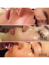 レヴィア(REVIA)/レディースフォトセラピー