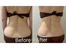 ゾウケイ(ZOKEI)/モニター3回お腹・腰回り