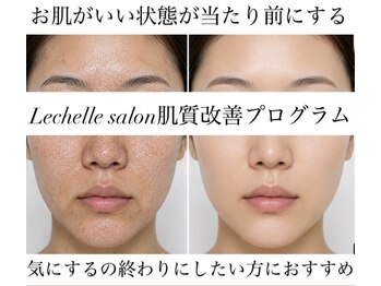 レシェルサロン(Lechelle Salon)の写真/毛穴にお悩みの方必見！福岡天神・薬院の人気サロンの毛穴改善ハーブピーリング でつるんっと毛穴陶器肌♪