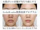 レシェルサロン(Lechelle Salon)の写真/毛穴にお悩みの方必見！福岡天神・薬院の人気サロンの毛穴改善ハーブピーリング でつるんっと毛穴陶器肌♪