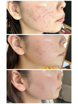 ルアンエステティック(RUAN esthetic)の写真/その肌悩み、一人で諦めないで。あなたに合う肌質改善でニキビ・毛穴・くすみ知らずの白玉水光肌へ