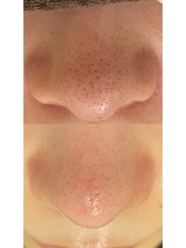 ネイル&アイラッシュ ルミア(Nail & Eyelash LUMIA)/毛穴エクストラクションプロ