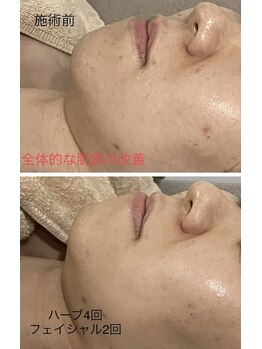 エメ 心斎橋(Aimer)/ハーブピーリングでニキビケア