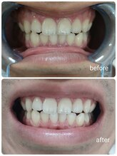 エクシアホワイトニング 岡山駅前店/ホワイトニングビフォーアフター