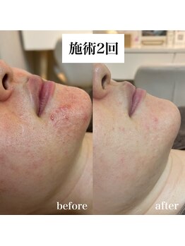 リニューサロン 本院(renew salon)/赤み・ニキビに