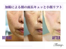 サンク(Thanq)/口元マリオネットほうれい線ケア