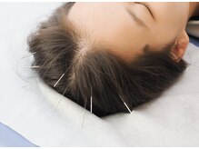 すがはら鍼灸院の雰囲気（痛みには最大限配慮して、鍼の細さも選べます。）