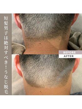 メンズラボ 京都駅前店/短髪男子は必須！うなじ脱毛