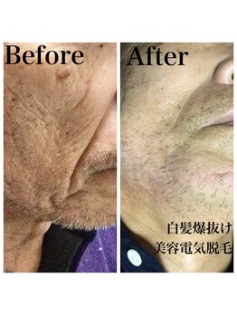 トータルメンズエステ キング(KING)/●眉やヒゲ、VIOの白髪脱毛●