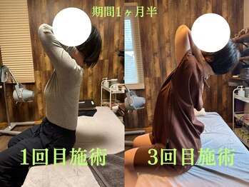 アポヨ鍼灸院(APOYO鍼灸院)/背中の張り　before/after