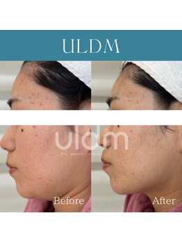 ハナイロ(hana-iro)/コラーゲンフィラー+LDM