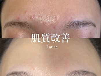 ラティエ(Latier)/ハーブピーリング1回目