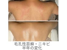 ハーブピーリングで肌管理！ツヤ肌に！ニキビ/フェイシャル/シミ