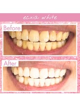エクシアホワイト 倉吉店(ecxia white)/ビフォーアフター