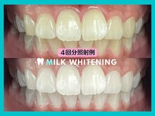 ミルクホワイトニング 新大村店(Milkホワイトニング)/★施術例
