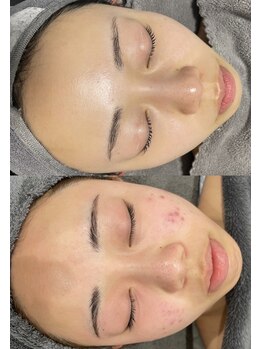 レクシア(LEXIA)/肌質改善症例｜繰り返しニキビ