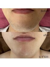 シャレールオム(Chareir Homme)/ヒゲ脱毛６回のビフォーアフター