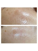 シャルム(CHARME)/美容液【イオン導入】