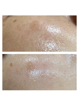 シャルム(CHARME)/美容液【イオン導入】