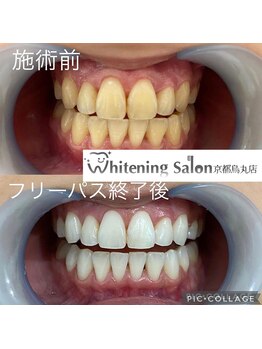ホワイトニングサロン 京都烏丸店/ホワイトニング施術例