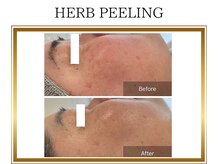 ロージー(ROSY)/ハーブピーリング/阿南/徳島