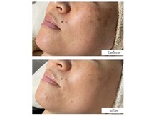 コンフィデンスサロン(Confidence Salon)/シミケア