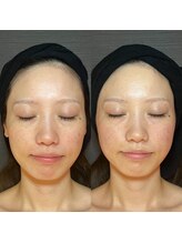 エラ(ella)/歪み矯正コルギ