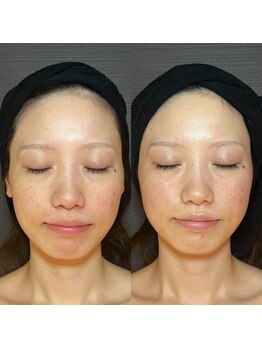 エラ(ella)/歪み矯正コルギ