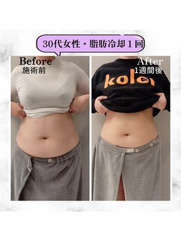 グランディールアン(GRANDIR UN)/施術直から1週間でこの変化