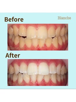 ホワイトニングサロン Blanche 心斎橋店/ビフォーアフター