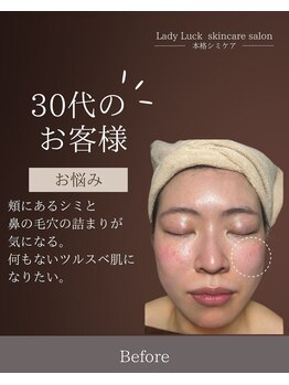 レディラック 大阪梅田本店(Lady Luck)/シミ毛穴集中ケアコース