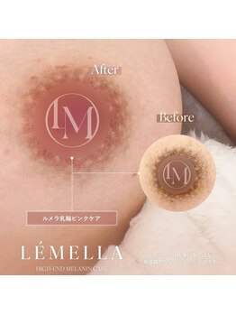 LB BEAUTY SALONの写真/【ルメラモニター募集】人気部位×気になる部位のセットが30％OFF!17,000円の豪華アフタークリーム特典も♪