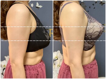 サロン フェリ(salon Feerie)/バストの高さは若さ！