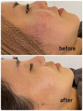 マーキュリー(Mercury)/ハーブピーリングのお客様