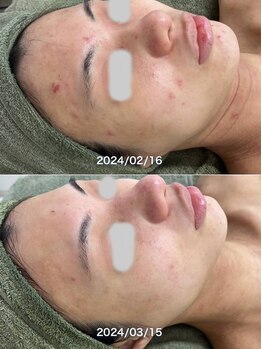 サロンドジェシカ(salon de Jessica)/プラズマ+ハーブピーリング
