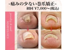 マーベラス(MARVELOUS)の雰囲気（☆巻爪ケア、痛みや形状の改善ジェルネイルでツヤツヤお仕上げ）