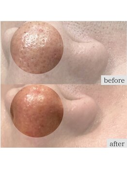 ダリアビューティー(Dahlia Beauty)/毛穴の黒ずみを除去したい！