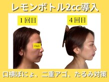 クラリス(Claris)/レモンボトルフェイシャル